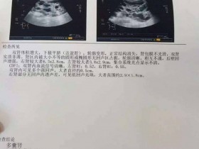 带您了解遗传性肾病:多囊肾