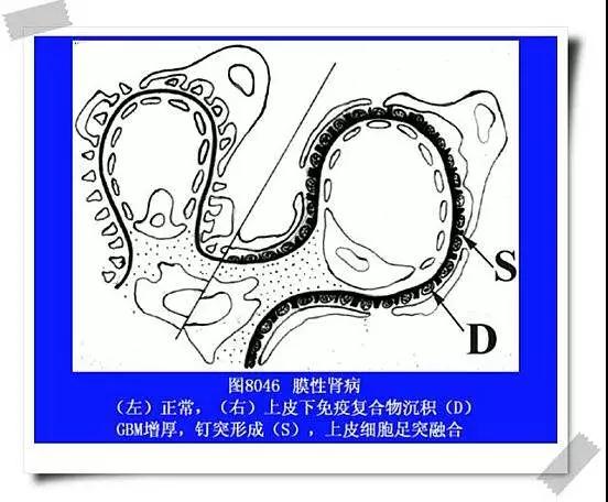 膜性肾病预后